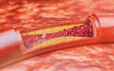 Xơ vữa động mạch cảnh gây nguy hiểm thế nào?