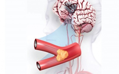 Mối liên hệ giữa nhồi máu não và xơ vữa động mạch