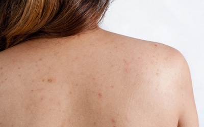 “Bỏ túi” bí kíp trị mụn lưng ngay tại nhà