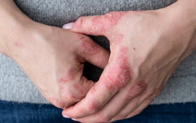 Những lầm tưởng trong quá trình điều trị bệnh viêm khớp vảy nến