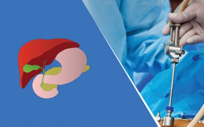 Mổ sỏi mật như thế nào, cần chuẩn bị gì trước và sau khi mổ?