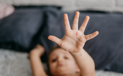 Thủy đậu và những biến chứng nguy hiểm với sức khỏe