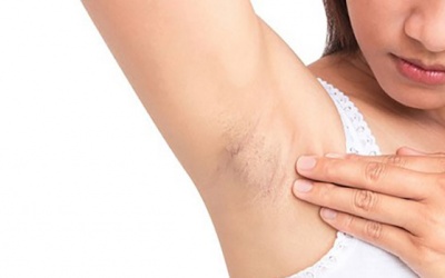 6 bất thường ở nách cảnh báo vấn đề sức khỏe của bạn