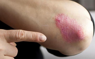 6 cách cải thiện bệnh vảy nến thể mảng tại nhà an toàn, hiệu quả