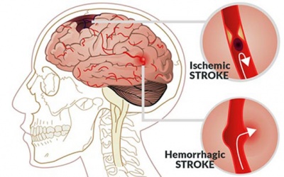 Tai biến nhẹ, đừng coi thường kẻo nhận hậu quả nặng nề