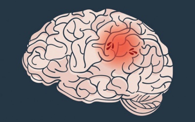 Những điều cần biết về đột quỵ não lần hai và cách phòng ngừa