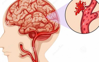 Làm thế nào đề phòng ngừa tai biến mạch máu não?