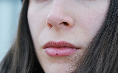 Bí quyết chăm sóc đôi môi khô nẻ trong mùa Đông