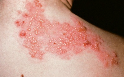  Tất tần tật về thuốc trị zona bạn cần phải biết