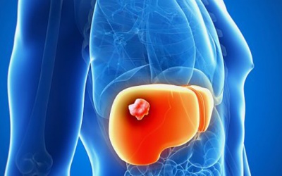 Những điều cần biết về ung thư gan nguyên phát