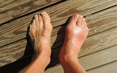 Dấu hiệu bệnh gout ở chân và cách kiểm soát bệnh từ thảo dược