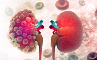 6 cách giảm nguy cơ mắc bệnh thận