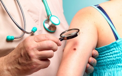 6 dấu hiệu cảnh báo sớm bệnh ung thư da