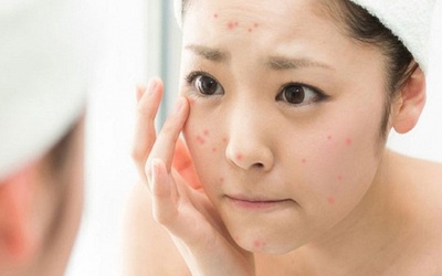 Làm thế nào để trị mụn tại nhà an toàn? 