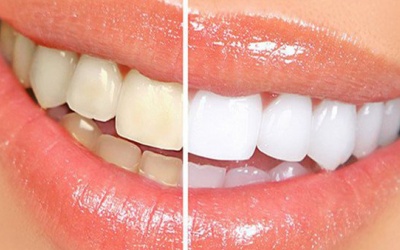 “Điểm mặt” 6 thói quen khiến răng bạn ố vàng