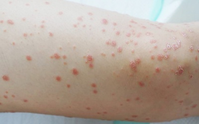 Biện pháp giúp cải thiện bệnh vảy nến thể giọt tại nhà hiệu quả