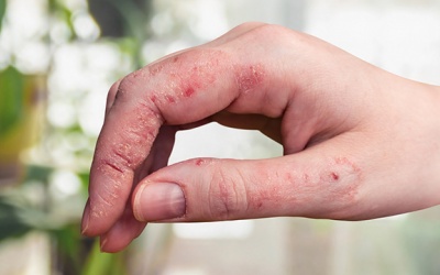 Cách chăm sóc da khi mắc bệnh chàm ở bàn tay