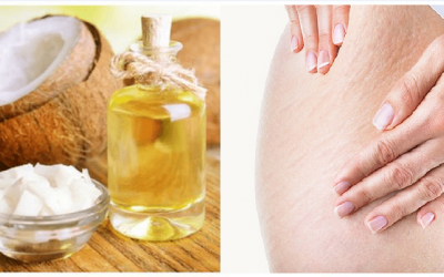 Bạn đã biết cách dùng dầu dừa để trị rạn da an toàn?