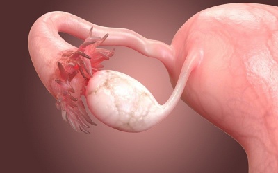 Nhận biết u nang buồng trứng và cách cải thiện bệnh hiệu quả