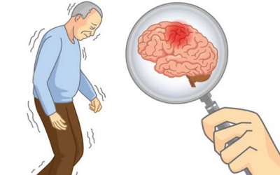 Đột quỵ nhồi máu não: Hiểu về bệnh để điều trị đúng cách