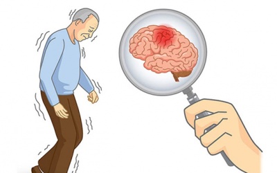 5 giai đoạn bệnh Parkinson và lưu ý điều trị cho từng giai đoạn