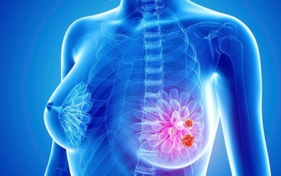 Những bước tiến trong việc tiếp cận các liệu pháp điều trị ung thư vú