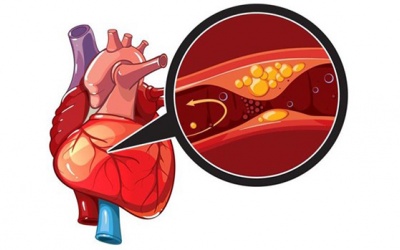 Thiếu máu cơ tim là gì, bệnh có những dạng nào?