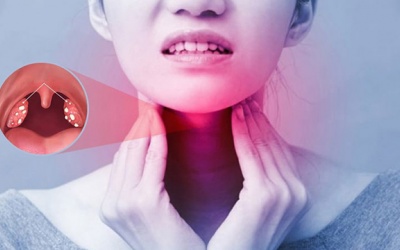 Phục hồi sức khỏe sau cắt amidan hốc mủ
