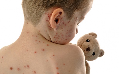 Bệnh sởi ở trẻ nguy hiểm thế nào, mắc bao lâu sẽ khỏi?