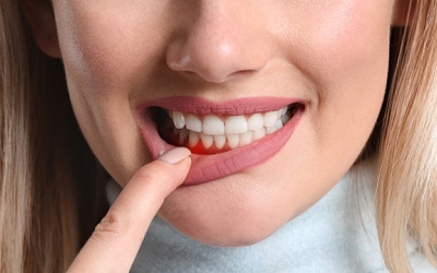 Làm thế nào để ngăn ngừa viêm nha chu tái phát?