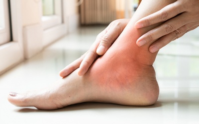 Những điều cần tránh khi điều trị gout tại nhà