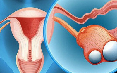 Đừng chủ quan với bệnh u nang buồng trứng