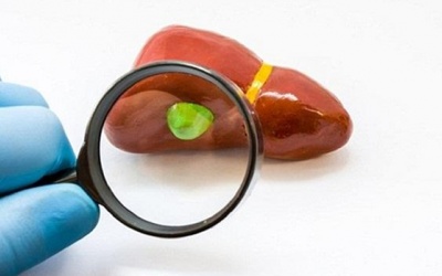 Sỏi mật 8mm có nguy hiểm không, nên điều trị thế nào?