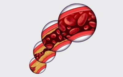 Thiếu máu cơ tim nhẹ có dấu hiệu gì, có dễ trở nặng không?