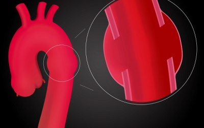 Những điều cần biết về phình động mạch chủ ngực