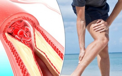 Xơ vữa động mạch chân: Nguy cơ cắt cụt chân nếu không điều trị kịp thời