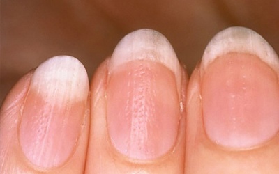 Triệu chứng điển hình của vảy nến móng tay và cách cải thiện