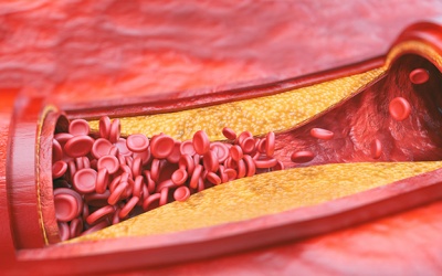Giải pháp từ thiên nhiên cho xơ vữa động mạch