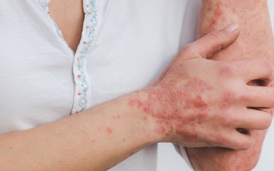 Cách chăm sóc da khi bị vảy nến thể mảng