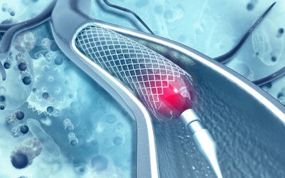 Đặt stent rồi có khỏi hẳn bệnh mạch vành không?