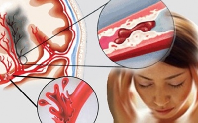 Làm sao để phòng ngừa tắc mạch máu não?