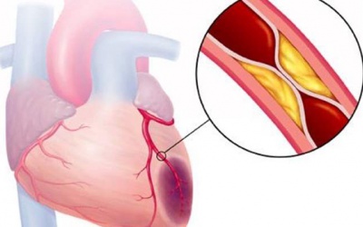 Chụp mạch vành có ý nghĩa thế nào trong chẩn đoán bệnh mạch vành?