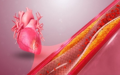 Hẹp mạch vành mức độ nào thì nên đặt stent?