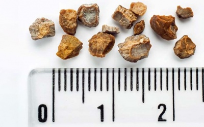 Sỏi túi mật 9mm nên điều trị thế nào, có nguy hiểm không?