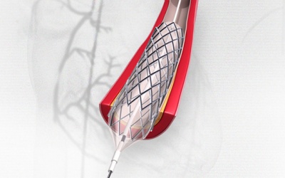 Bệnh mạch vành: Có thể đặt nhiều stent được không, nguy hiểm không?