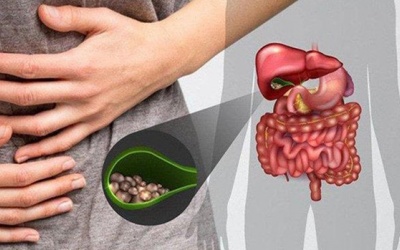 Sỏi mật 13mm có dùng TPBVSK Kim Đởm Khang được không?