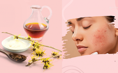 Chăm sóc da mụn với nước cây phỉ