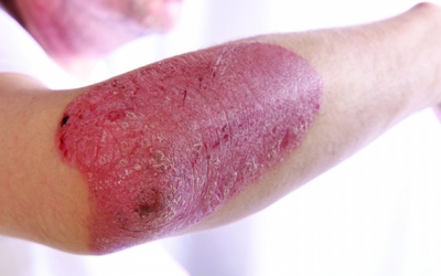 Người bị vảy nến thể mảng có nên phơi nắng không?