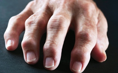 Người bị viêm khớp dạng thấp kiêng ăn gì? 