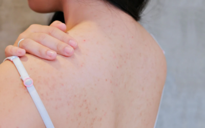 'Mách bạn' cách trị mụn lưng hiệu quả ngay tại nhà 